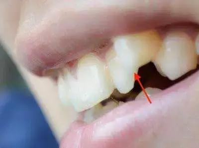 牙齿老是卡菜卡肉怎么办,牙齿卡肉导致牙痛