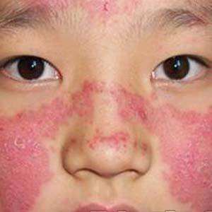 皮肤型红斑狼疮用什么药膏,皮肤型红斑狼疮的饮食