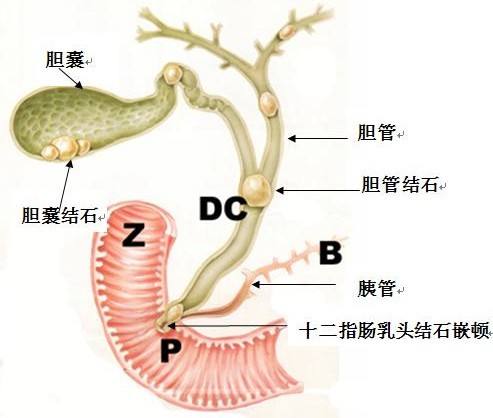 胆石症中医调理,胆石症和胆结石的区别