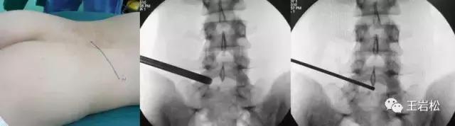 腰椎微创技术的临床应用,目前最热门腰椎微创技术椎间孔镜