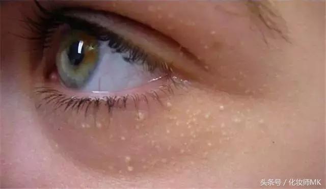 黑眼圈眼霜真的有用吗,黑眼圈眼袋用护肤品可以缓解吗