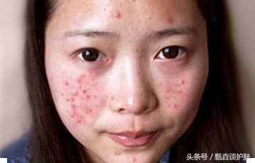 如何去除痘印,如何去除痘印留下的痣