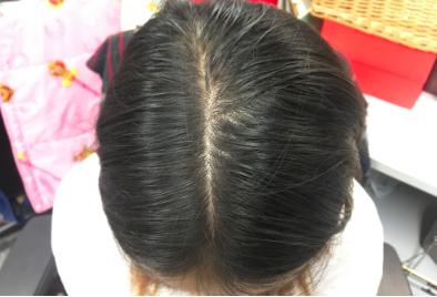 为什么没人敢去植发,为什么很多人都没有去植发