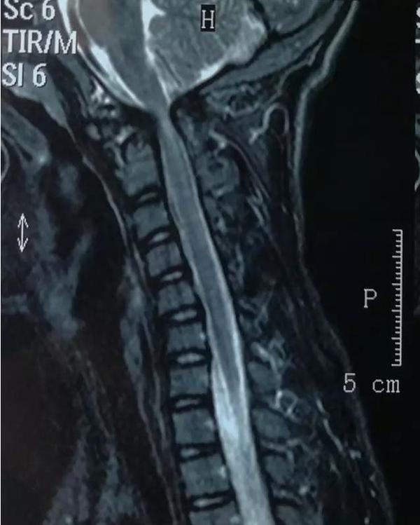 寰枢椎脱位手术适应症,寰枢椎脱位手术最广泛麻醉方法