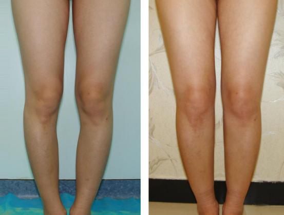 王明利自体脂肪填充好不好,王明利自体脂肪丰臀怎么样