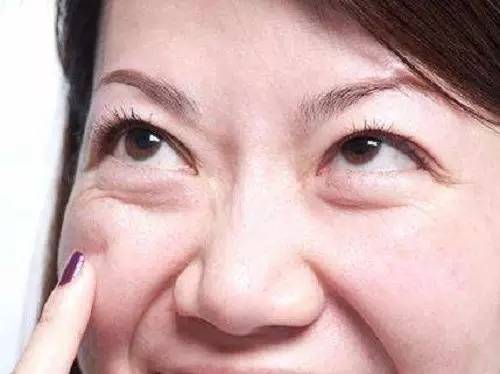 怎样区分眼袋卧蚕和双眼皮,怎样区分卧蚕和眼袋最简单的方法