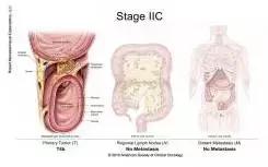 得了直肠癌怎么知道,你了解结直肠癌吗