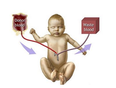 换血婴儿熊猫血,熊猫血宝宝溶血换血危险吗