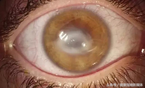 英国妹子用失明的教训告诉你，千万别让隐形眼镜沾上水