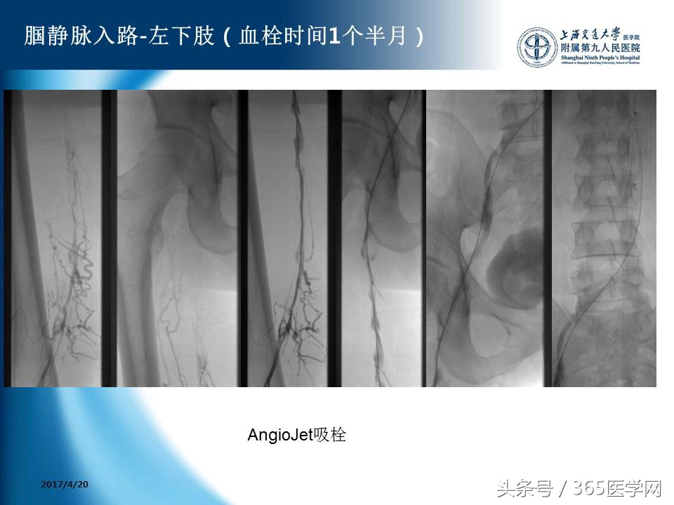 下肢静脉血栓植入滤器后的护理,下肢静脉血栓滤器植入后注意事项