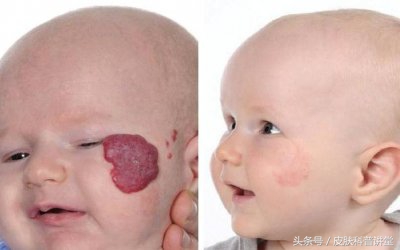 普萘洛尔治疗婴幼儿血管瘤的原因,普萘洛尔治疗血管瘤的注意事项