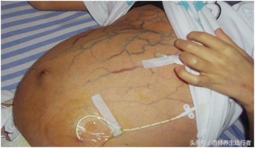 中国有多少人患乙肝,乙肝大三阳发展成肝硬化肝癌概率