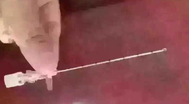 剖腹产麻药针,剖腹产脊椎打麻药的地方有个疙瘩