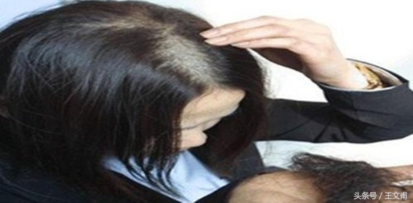 吸毒后头发掉了,吸毒后头发掉光了