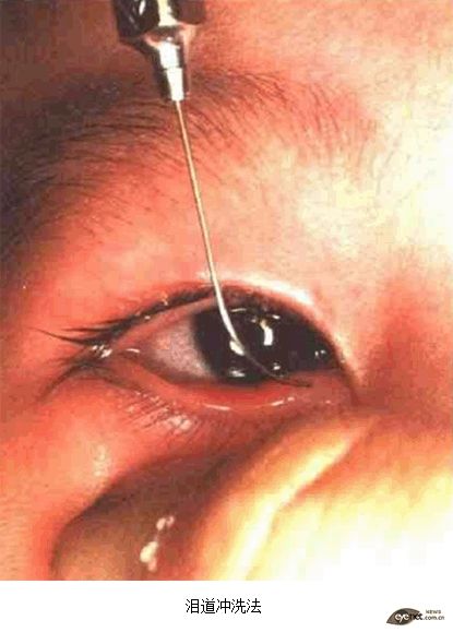 濠村効榧绘唱绠′笉閫氭墜鏈湁鍚庨仐鐥囧悧,榧绘唱绠′笉閫氭墜鏈灏戦挶