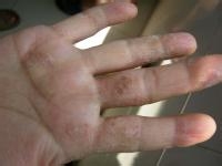 手脱皮是怎么回事怎么治疗,手脱皮是怎么回事怎么治