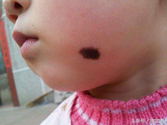 青色胎记会影响健康吗,小孩的胎记会影响身体吗