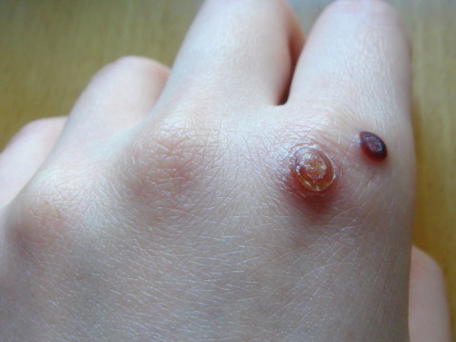 瘊子公母怎么分辨图片,瘊子分公母吗