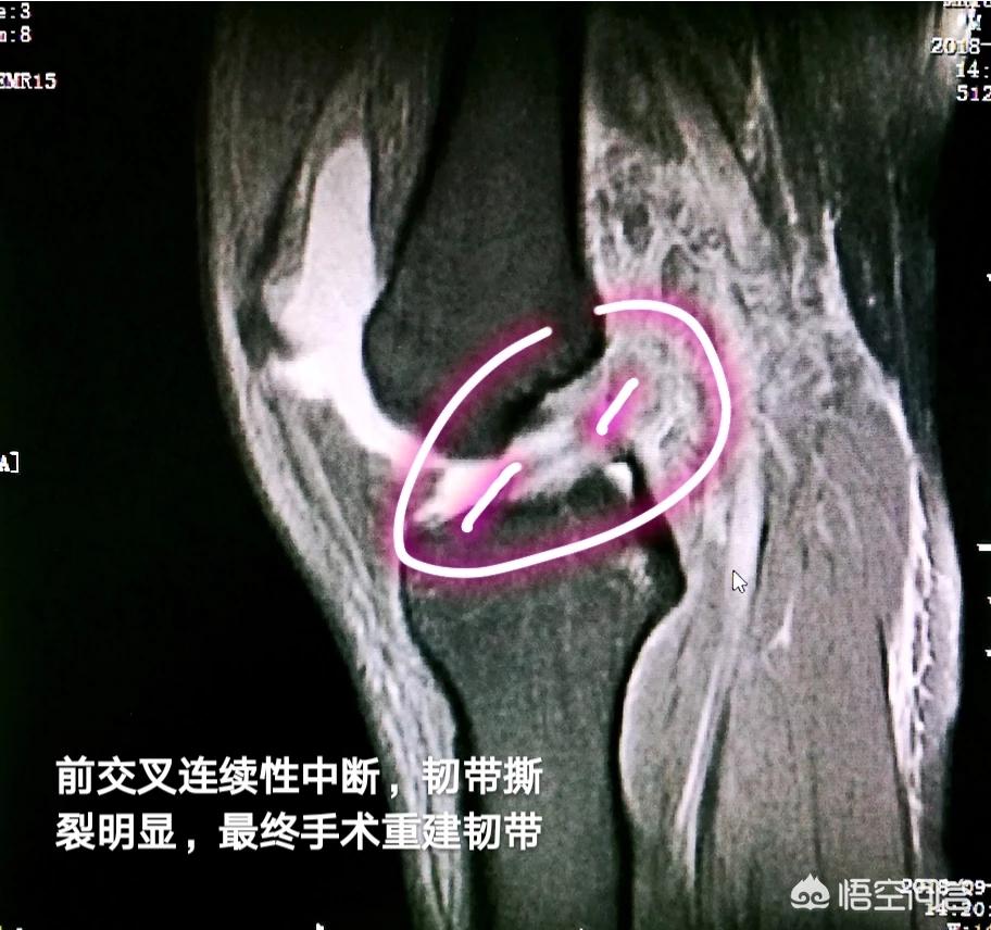 交叉韧带撕裂什么症状,交叉韧带撕裂怎么恢复正常