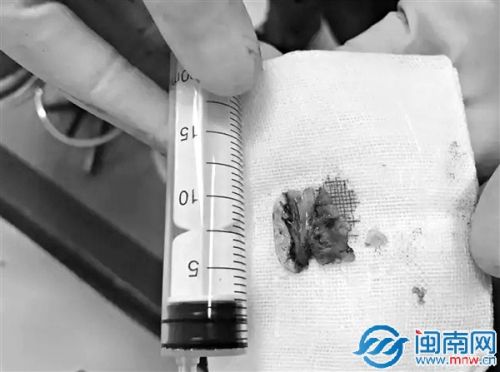 鱼汤被鱼刺喝卡喉,黄骨鱼鱼刺卡住了喉咙