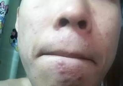 小一点的螨虫怎么消除,小螨虫最怕什么药