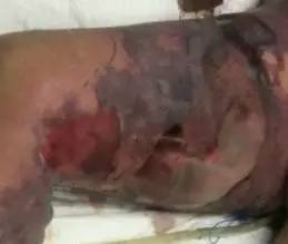 感冒脓毒血症,小孩感冒引起的脓毒血症