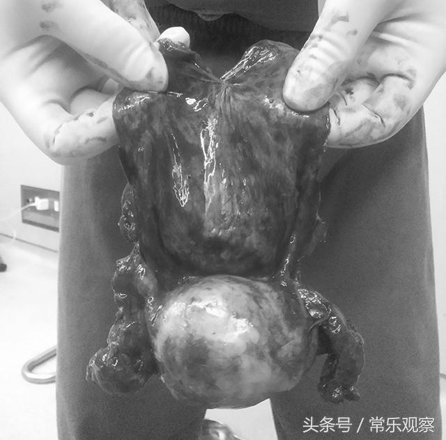 宫颈癌晚期患者的分泌物传染吗,宫颈癌晚期患者身上特有气味