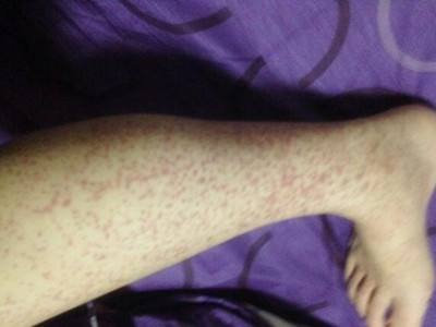 过敏性紫癜危害大，怎样治疗效果好？