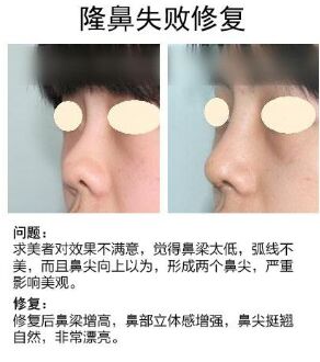 做了隆鼻手术怎么都不消肿,做隆鼻手术失败有哪些症状