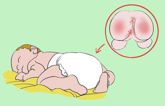 宝宝长期兜尿不湿有危害么,新生儿屁股天天兜尿不湿