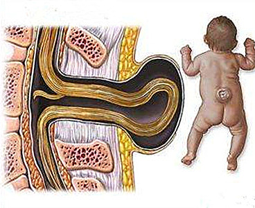 宝宝刚生下来就自带“小尾巴”！家长该怎么办？