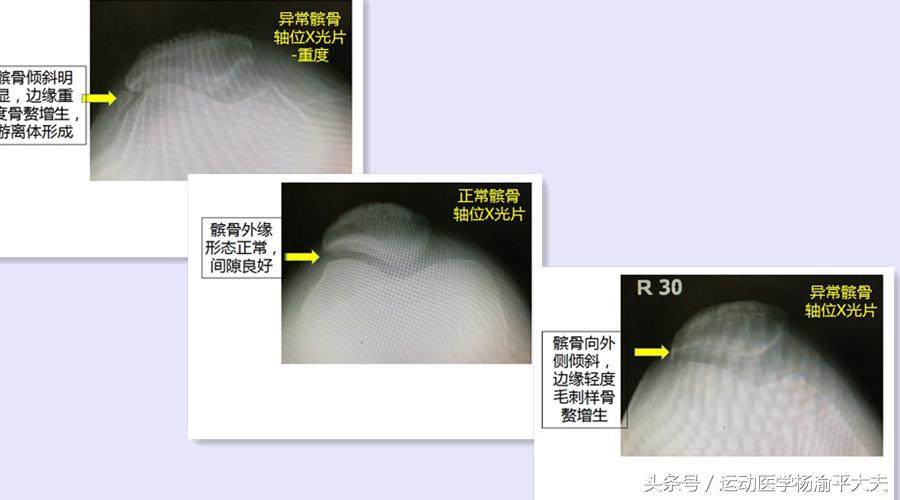上楼下楼膝关节疼喝什么药效果好,上楼下楼膝关节疼痛怎么回事