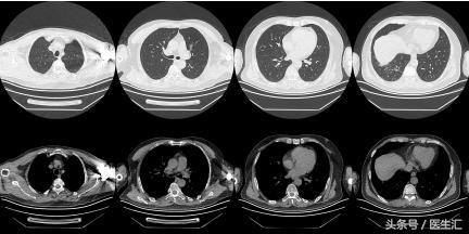 胸痛可能是肺的原因吗,胸痛咯血