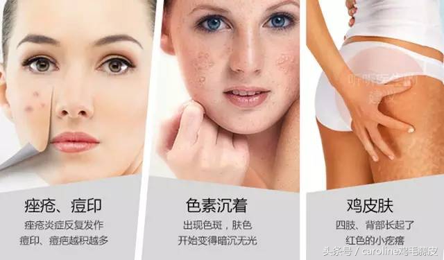 果酸用途及功效,果酸是治疗皮肤的什么