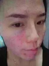 黄皮肤假货怎么识别,假货造成过敏