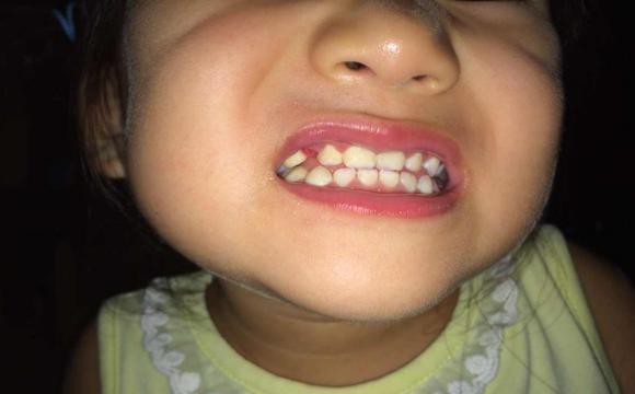 宝宝门牙往里抠是什么原因造成的,宝宝出牙上门牙长歪了怎么办