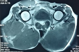 清华长庚多学科切除巨大骶骨脊索瘤让老人甩掉26.3斤巨臀