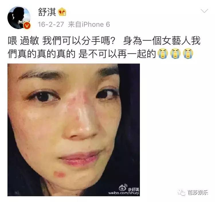舒淇过敏发作视频,舒淇过敏