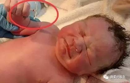 「扩散」陈素文:取环不是选择题!