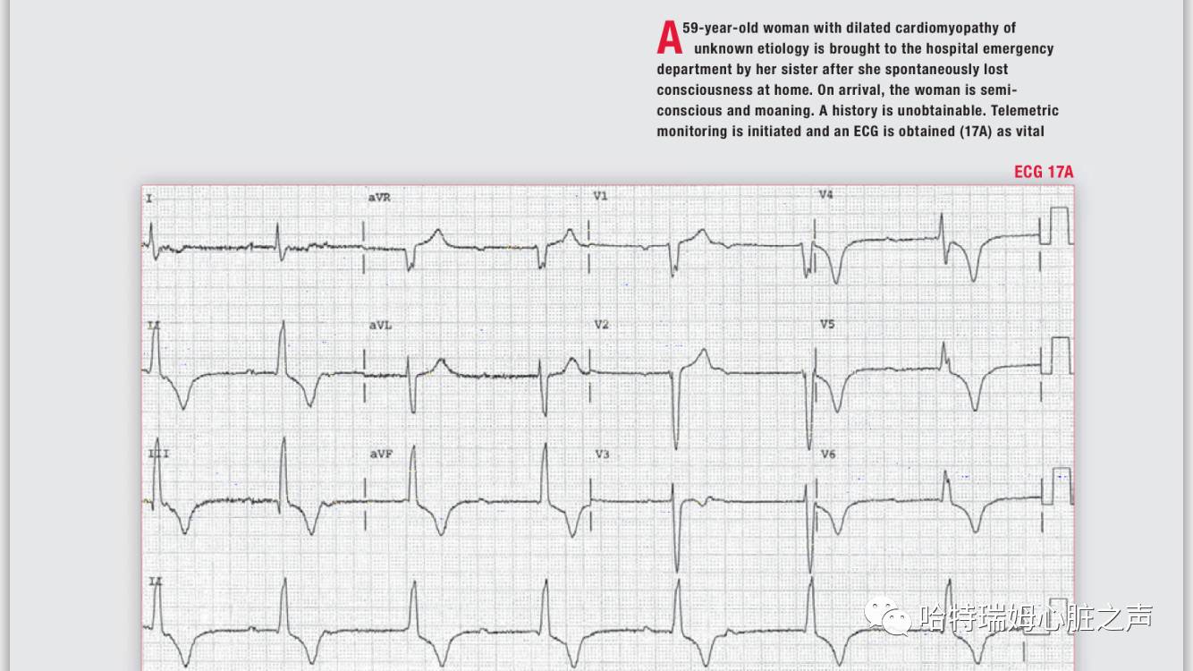 读心有术171,读心有术心电图