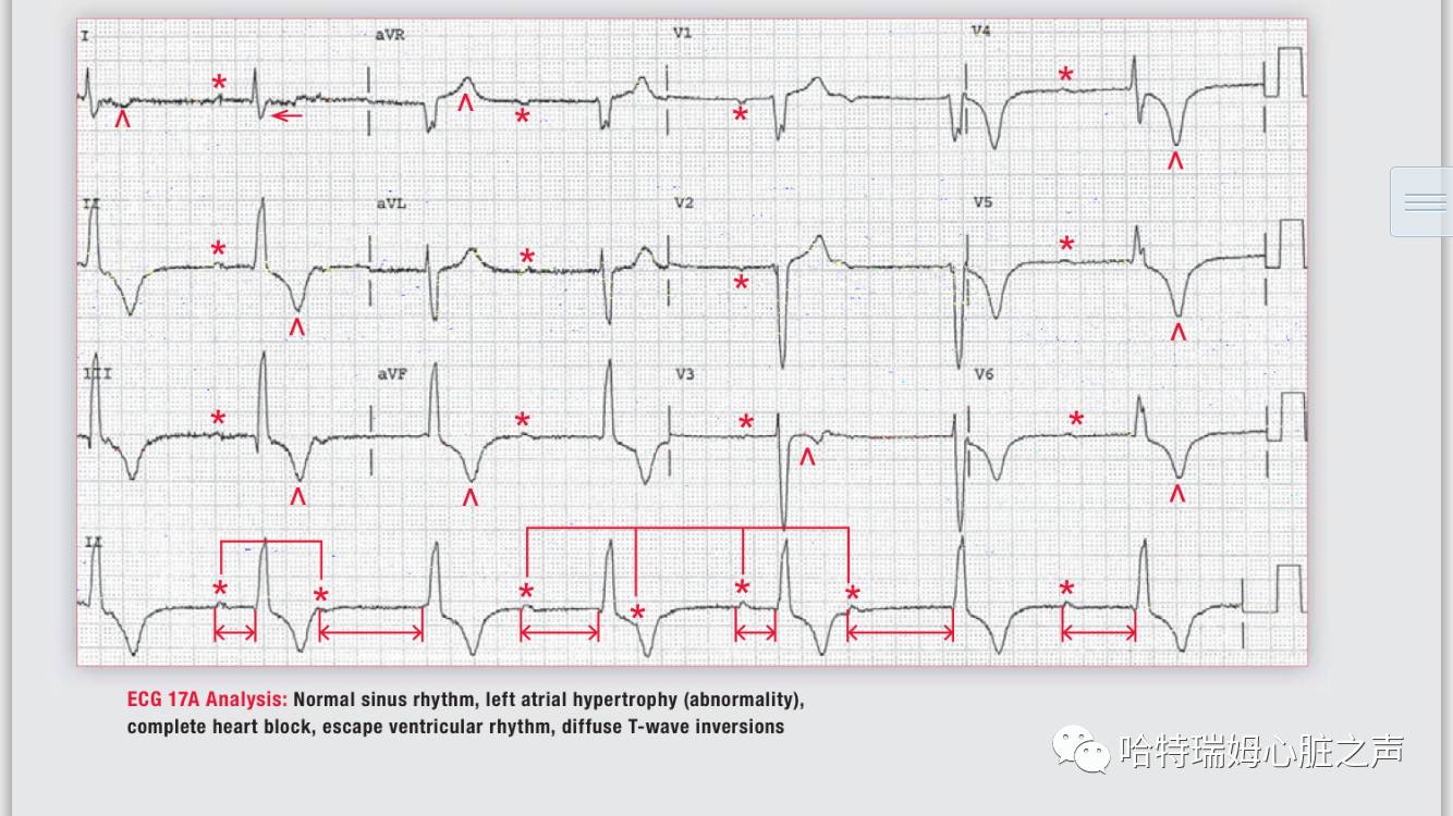 读心有术171,读心有术心电图
