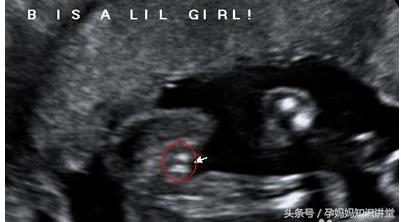 怎么看b超单判断胎儿怀孕,早孕b超图怎么看出胎儿性格