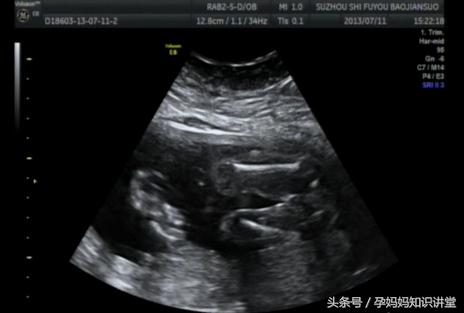 怎么看b超单判断胎儿怀孕,早孕b超图怎么看出胎儿性格