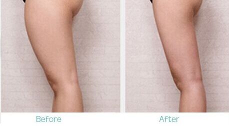 大腿抽脂后多久可以洗澡,大腿抽脂容易凹凸不平吗