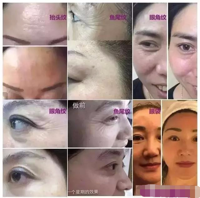 抢救假性眼纹、眼袋的黄金时间，错过你就老了