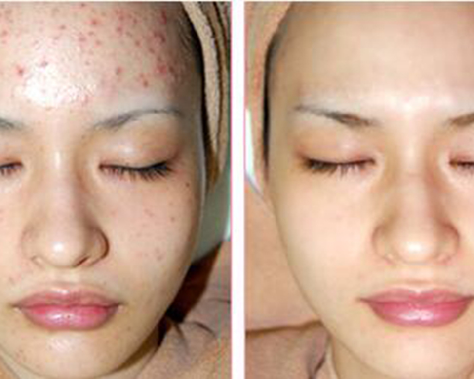 脸上长痘痘怎么快速消除,脸上的痘痘变成疮怎么办