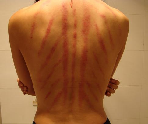 白癜风患者可以刮痧拔罐吗,白癜风处刮痧有好处吗