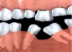 树脂修补缺失门牙的方法视频,牙齿缺失用树脂修补