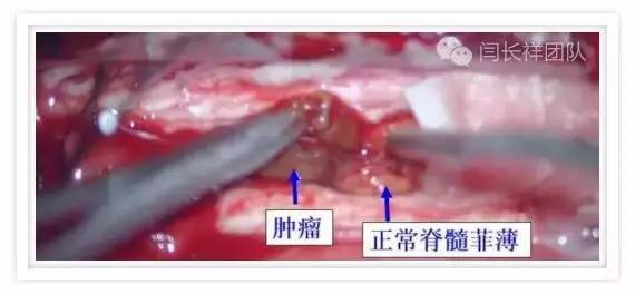 闫长祥脑膜瘤,闫长祥能治愈弥漫中线胶质瘤吗