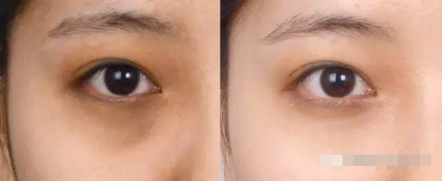 抢救假性眼纹、眼袋的黄金时间，错过你就老了